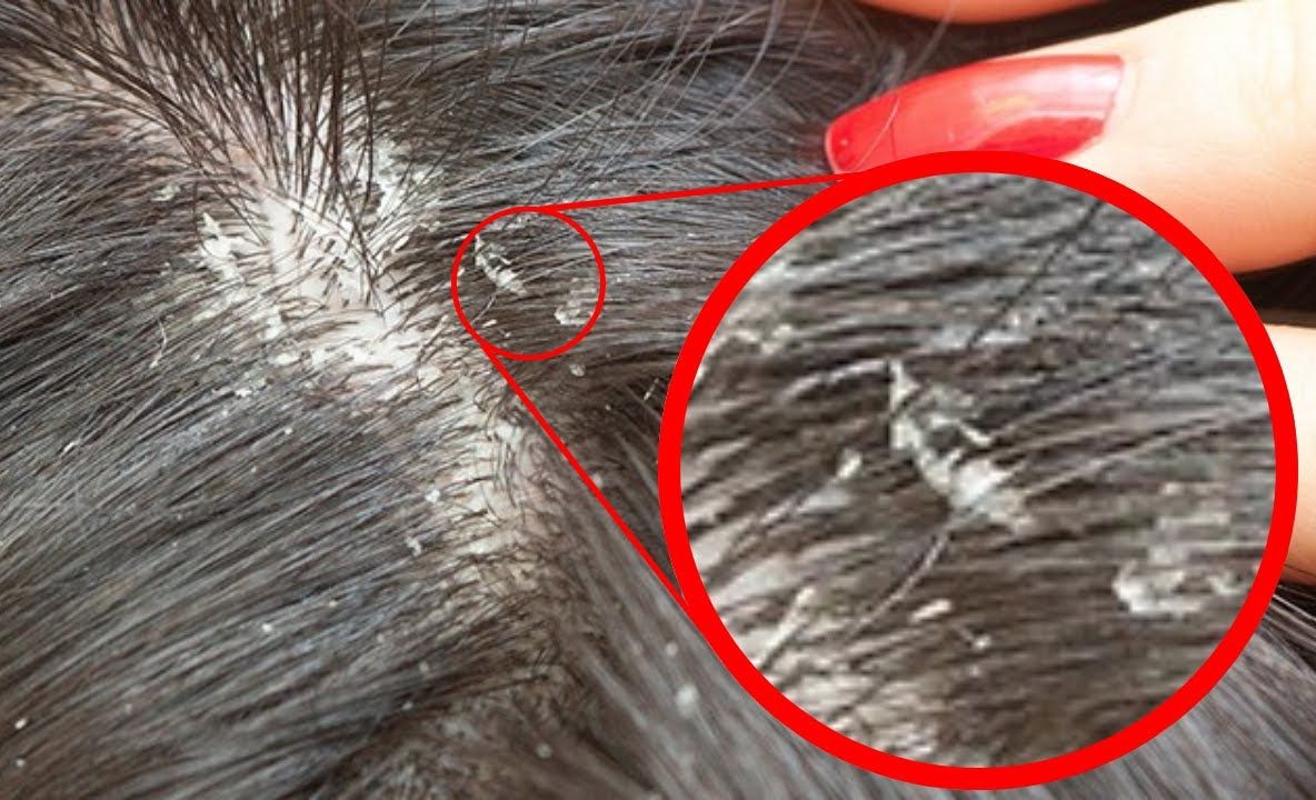 132 de elevi cu păduchi şi râie, depistaţi în şcolile gălăţene